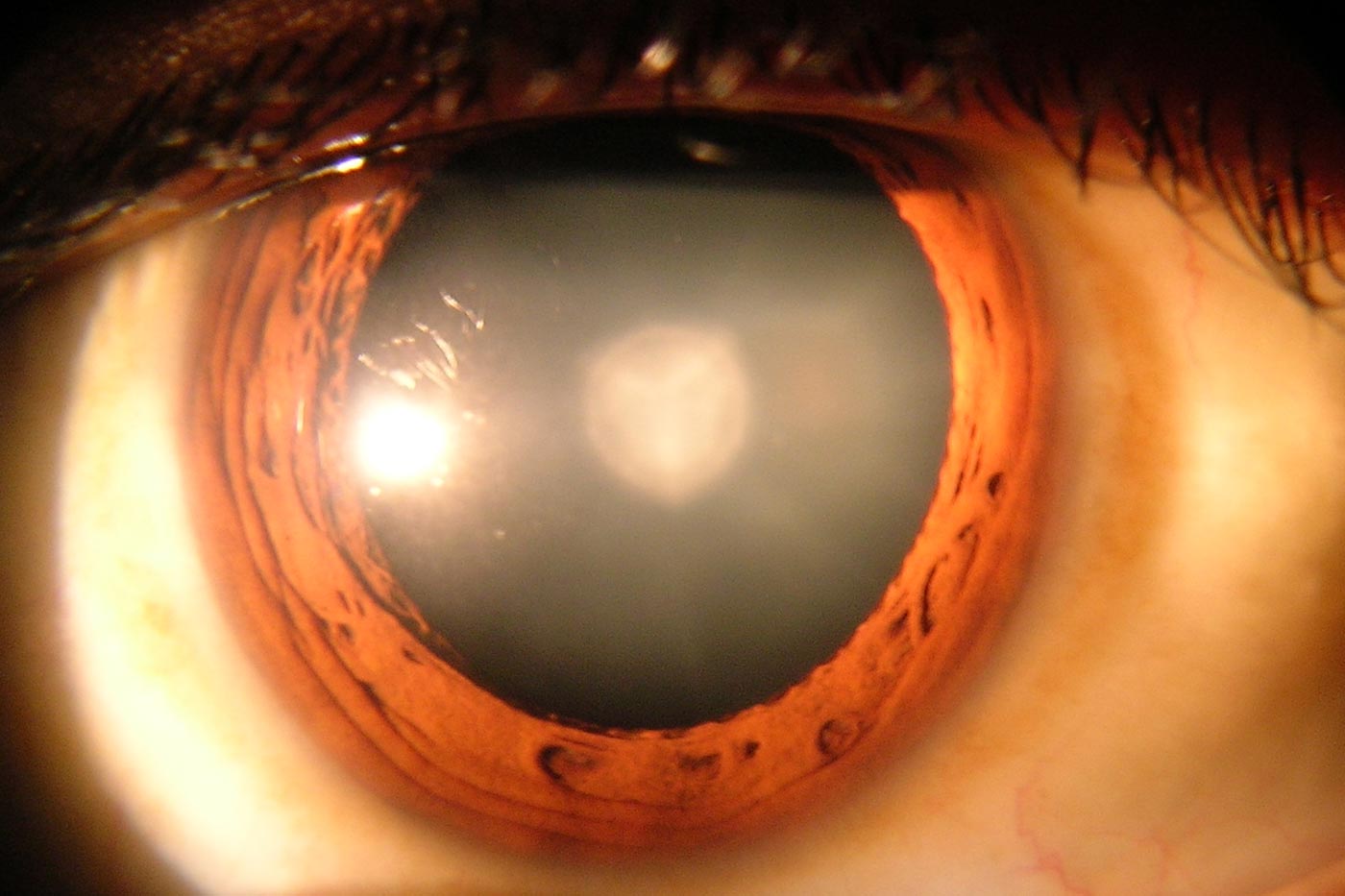 Cataracts. Image: Rakesh Ahuja, MD. Llicensed under the Creative Commons Attribution-Share Alike 3.0 Unported license.